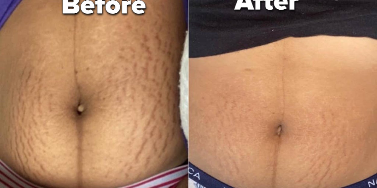 Bodybuilding Stretch Marks - Prevention & Treatment – TriLASTIN