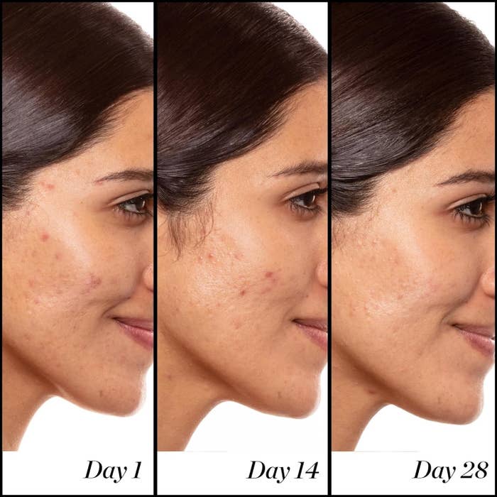 model showing progression of skin clearing up some thanks to the retinol serum