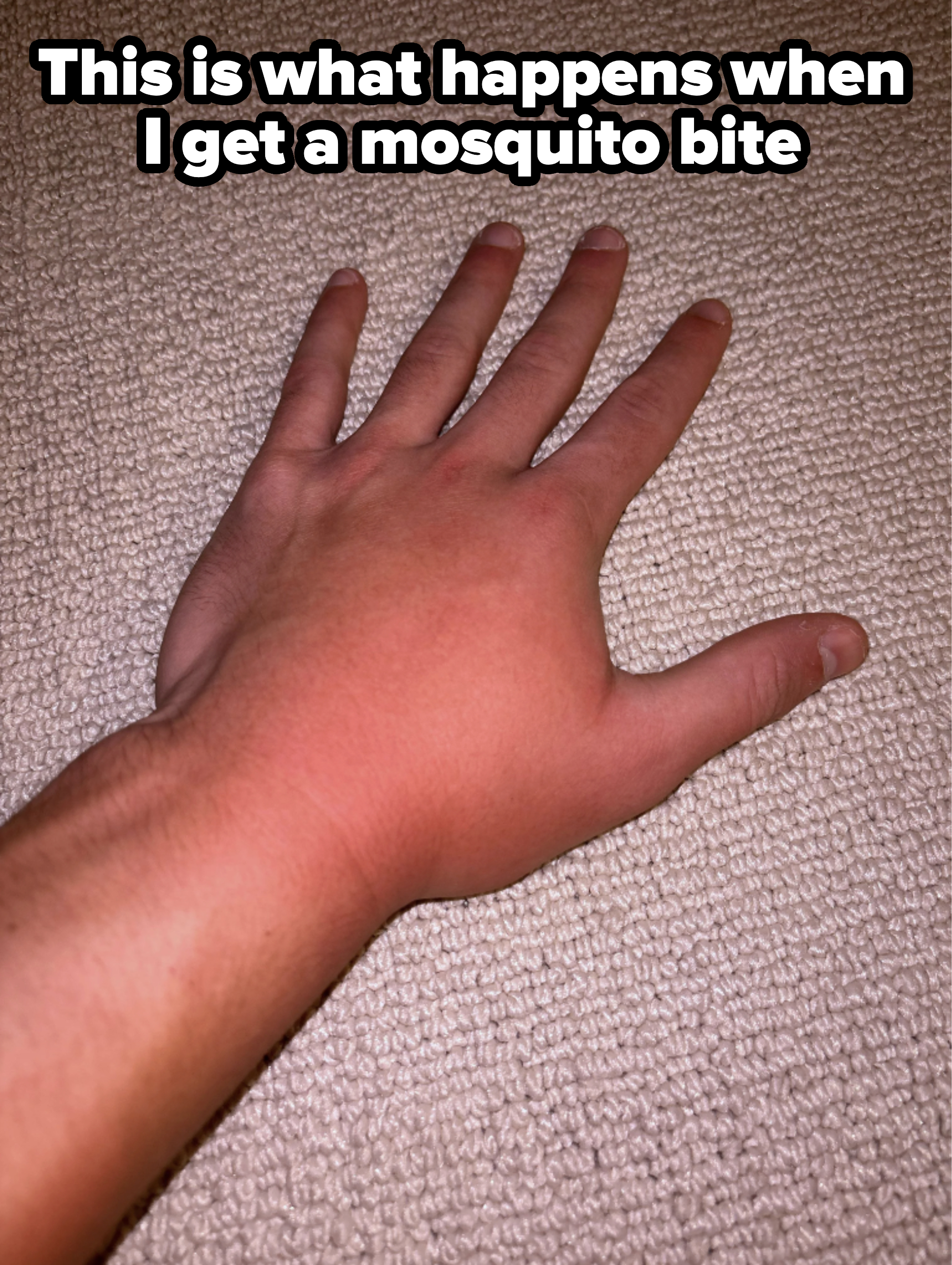a person&#x27;s swollen hand