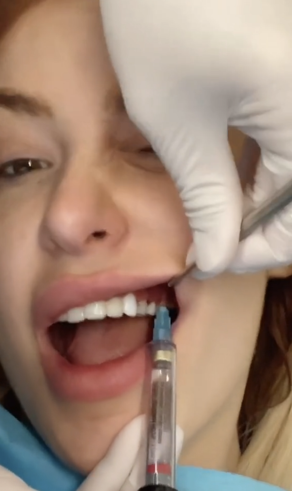 Close-up of Tana&#x27;s open mouth as her gum gets an injection