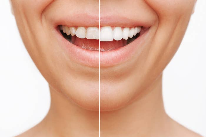 Side-by-side of a smile with and without veneers