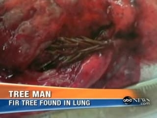 a piece of tree in someone&#x27;s lung