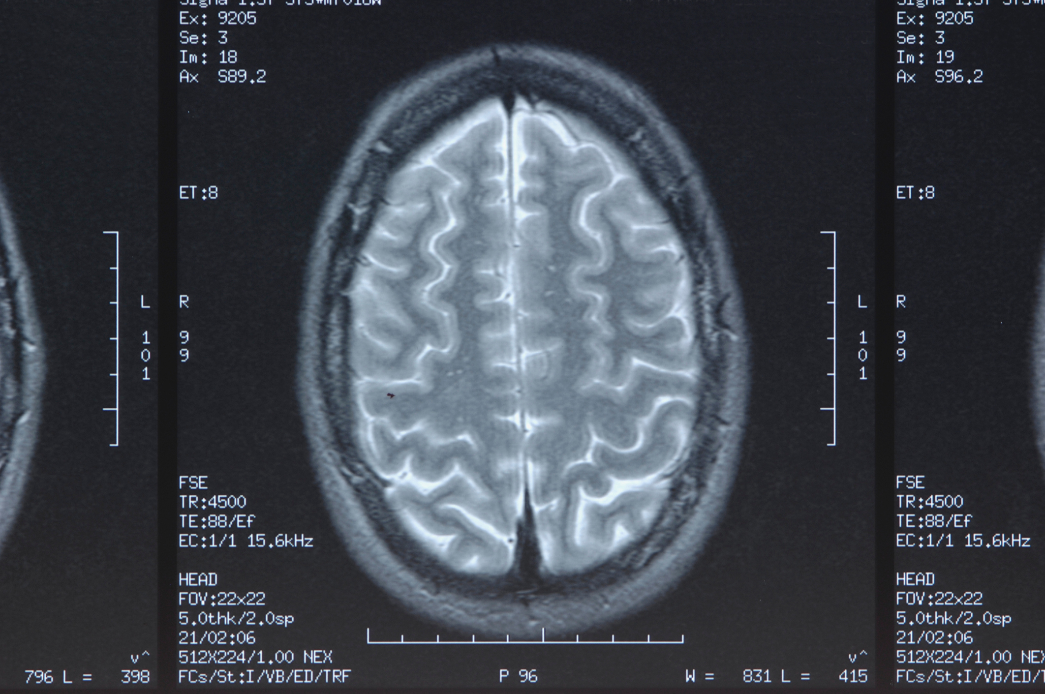a brain scan