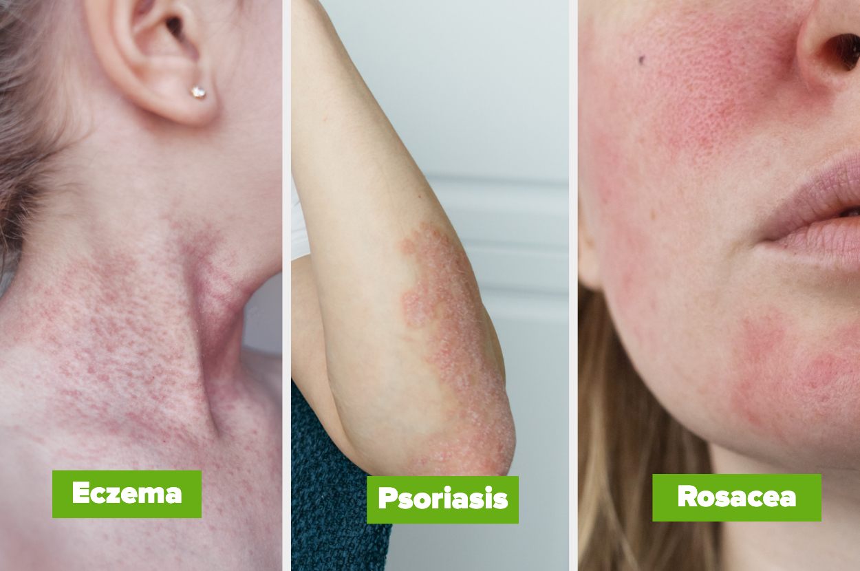 people with eczema, psoriasis and rosacea