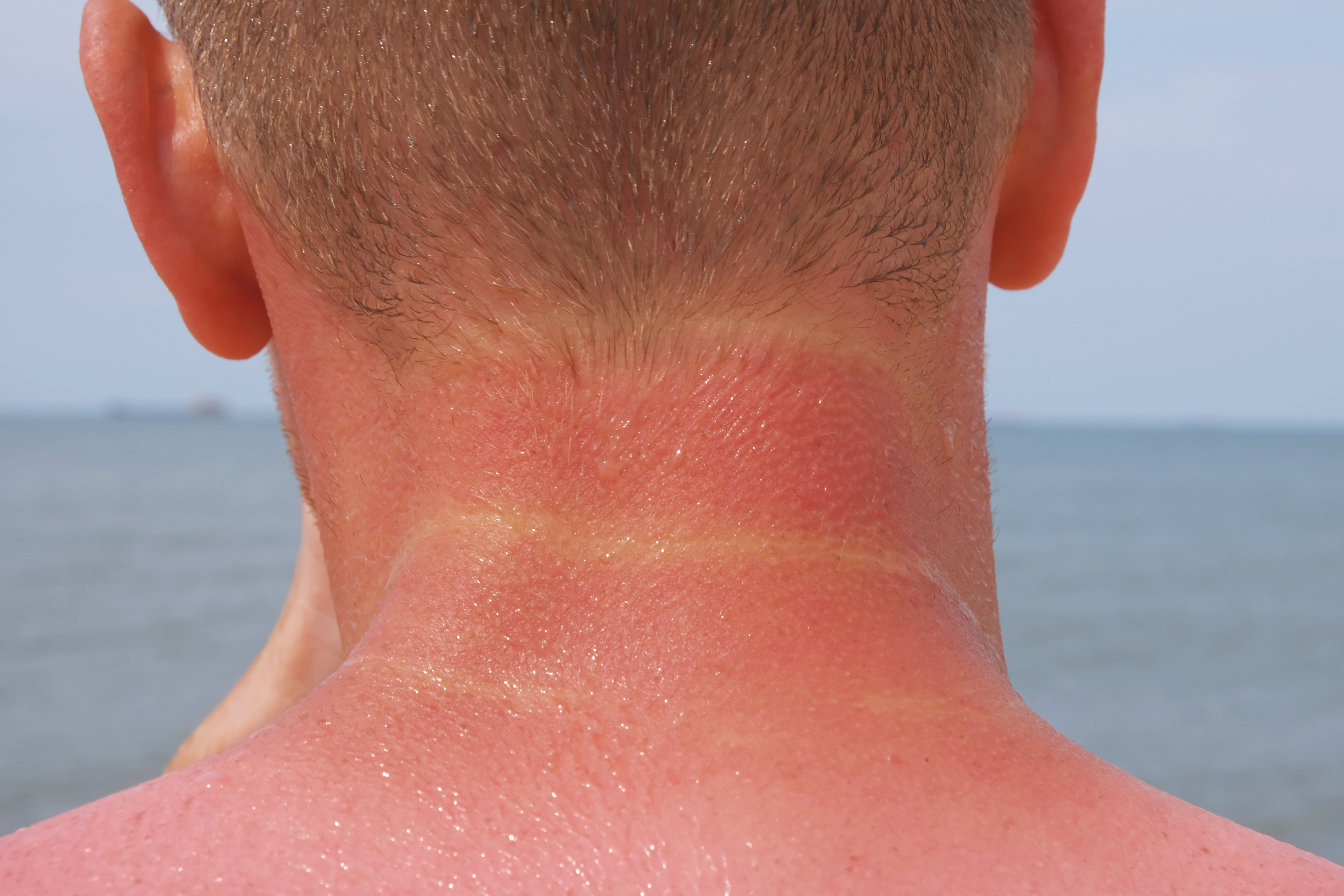 The man received sunburn on the seashore