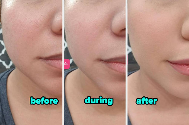 Korean skincare for acne scars new arrivals