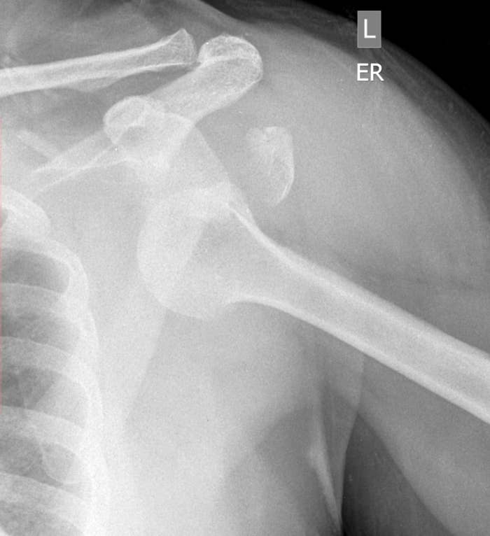 X-ray of a dislocated shoulder.