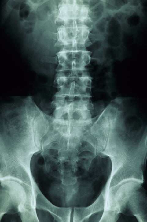 A scan of someone&#x27;s spine