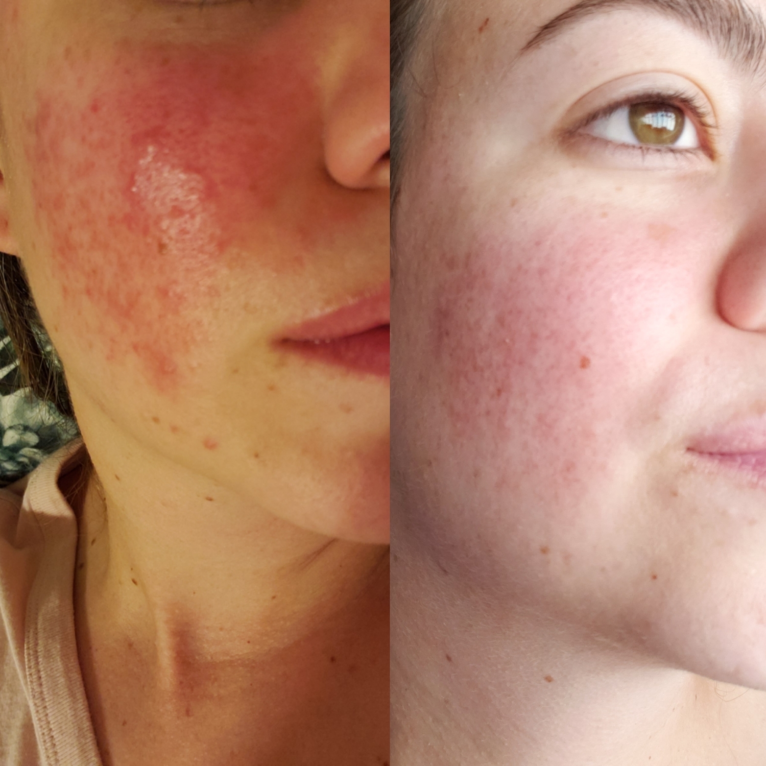 Reviewer with inflamed rosacea flare labeled before, and after with clear, calm skin