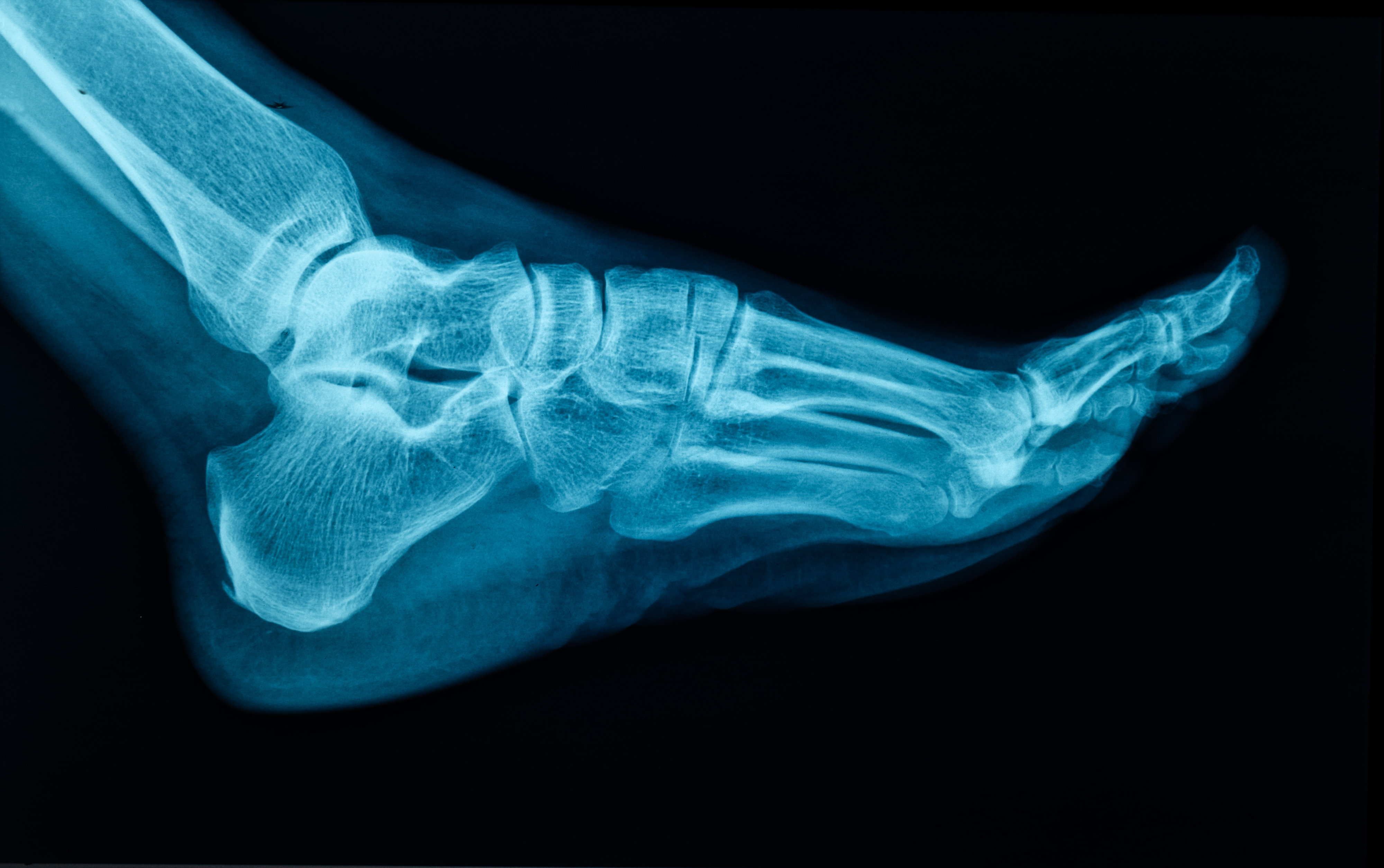 X-ray of someone&#x27;s foot