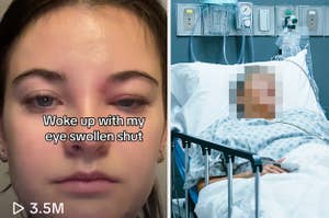 Brooke Hyland swollen eye with caption "woke up with my eye swollen shut" and person laying in hospital bed on the right