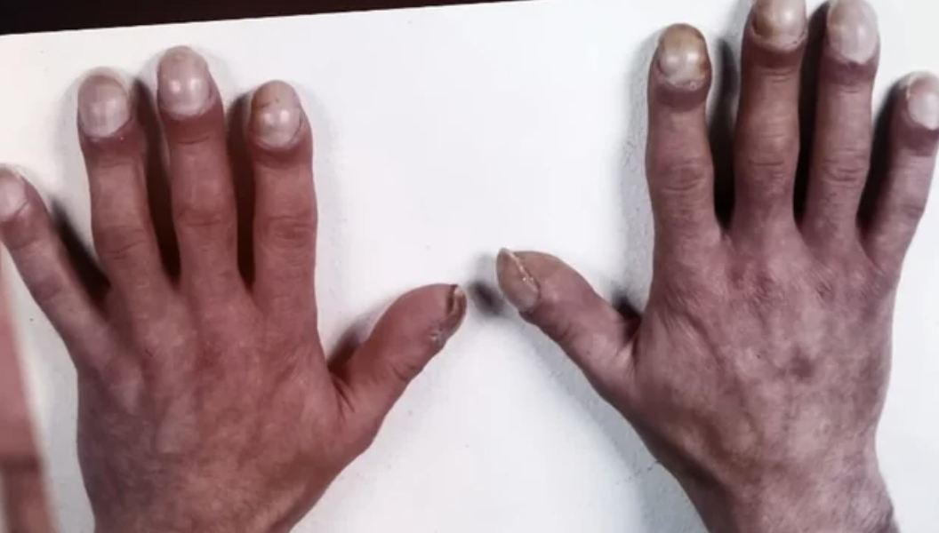 Close-up of hands with thick fingers, huge fingernail beds, and long, dirty fingernails
