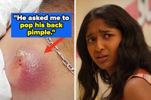 large pimple on the left with caption "he asked me to pop his back pimple" and disgusted reaction on the right