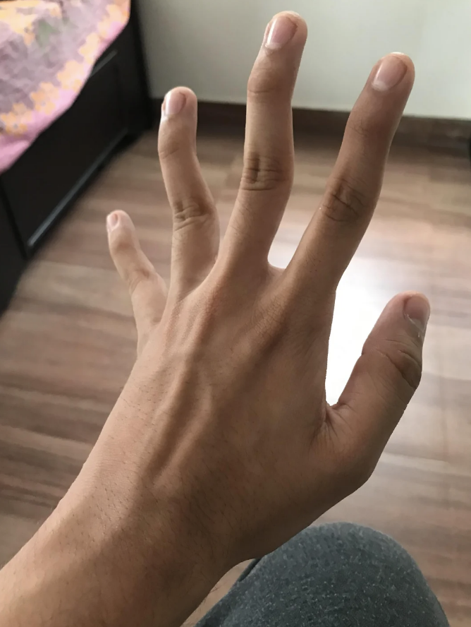 A person with crooked fingers