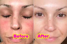 reviewers skin before and after using SOS spray to reduce redness