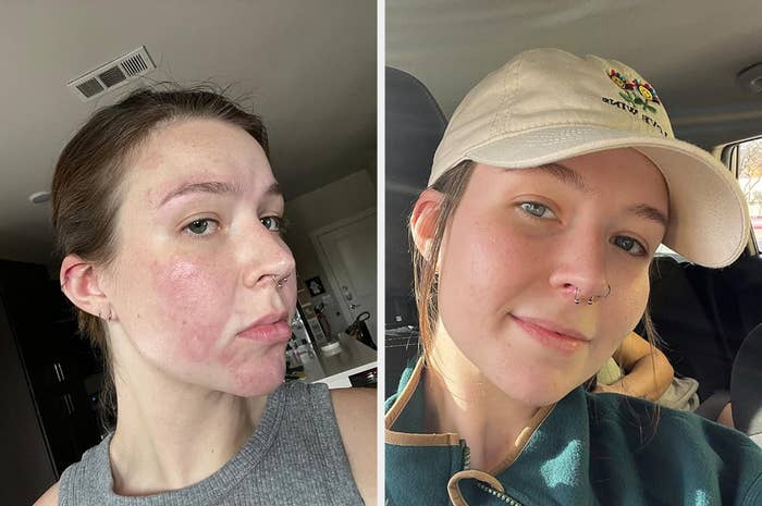 A reviewer&#x27;s skin in a before/after with reduced redness and irritation after