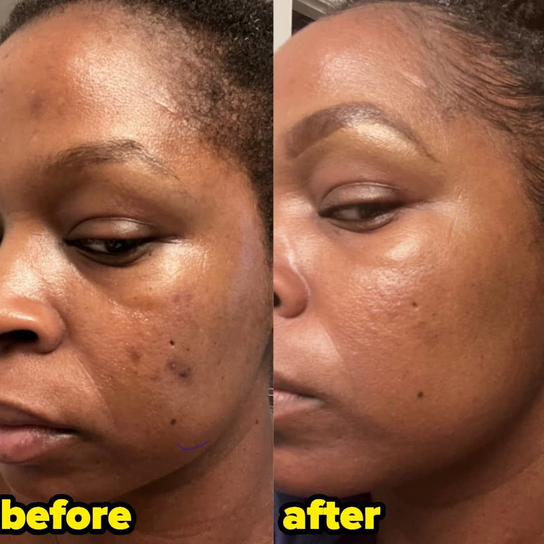 reviewer&#x27;s results of using Differin gel after five weeks, with the before picture showing breakouts and hyperpigmentation on their cheek and the after photo showing their face noticeably clearer without breakouts or hyperpigmentation