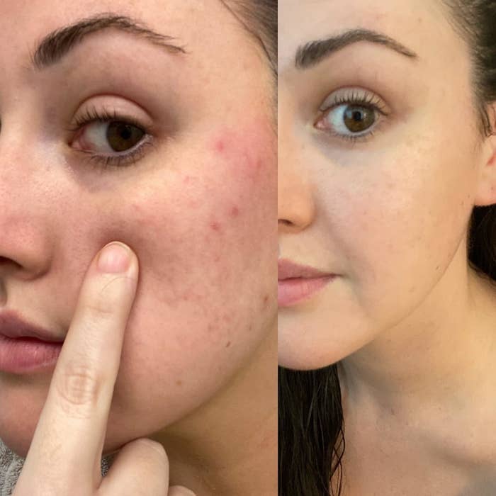 a before/after of a reviewer&#x27;s skin showing reduced redness and bumps