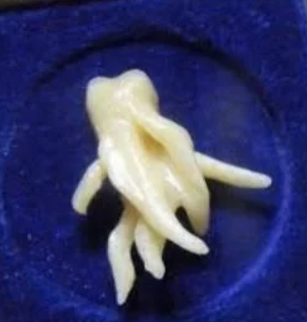 A wisdom tooth that looks like tentacles
