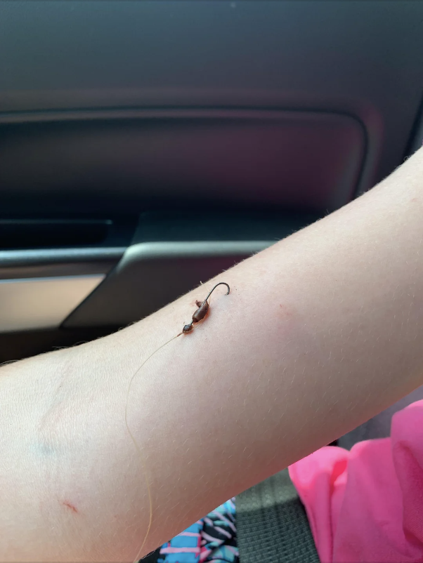 A fish hook in someone&#x27;s skin