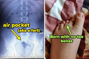 air pocket in x-ray (aka a fart) and person born with no toe bones