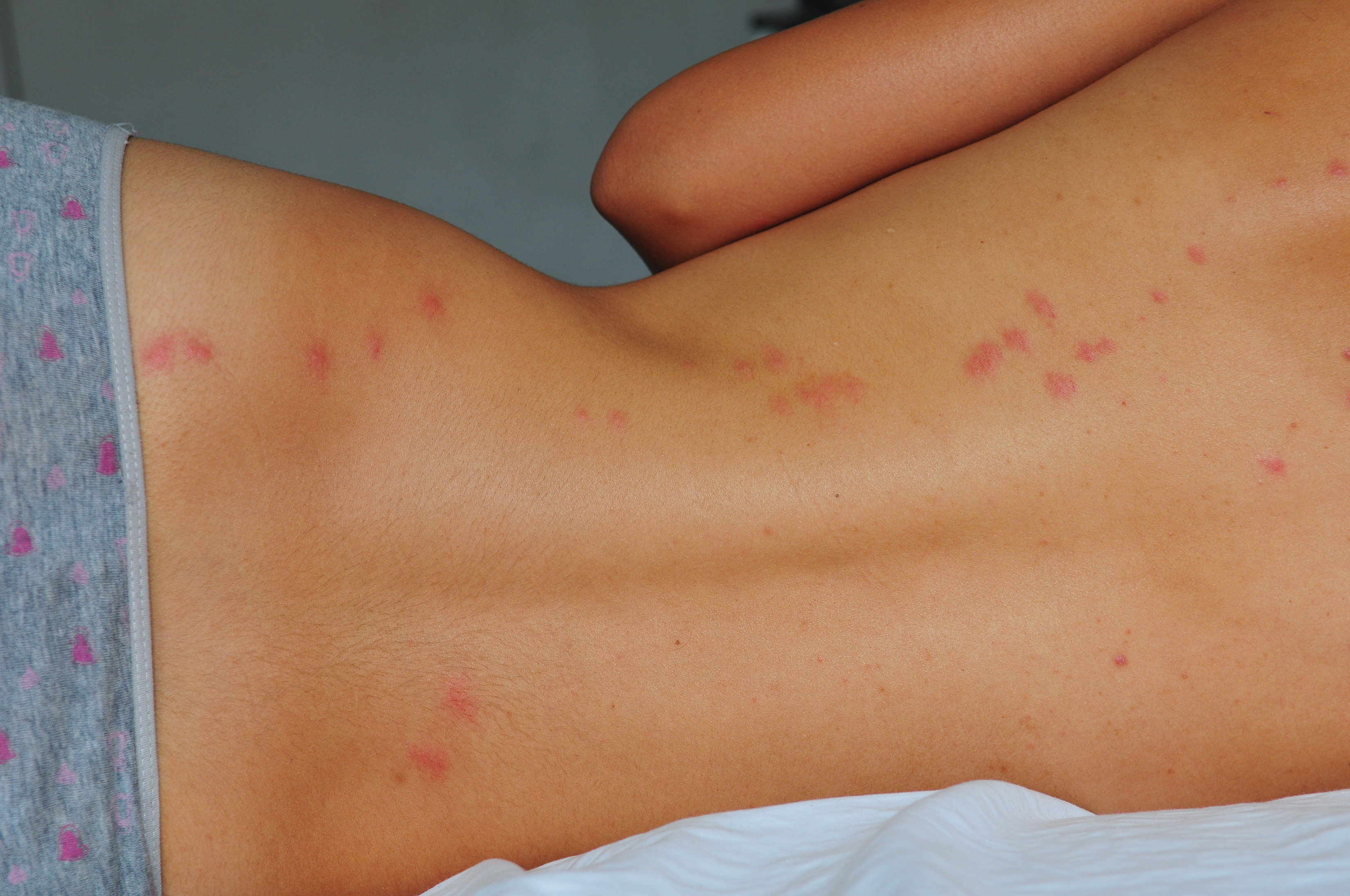 Two-day old lines of bedbug bites on a woman&#x27;s back