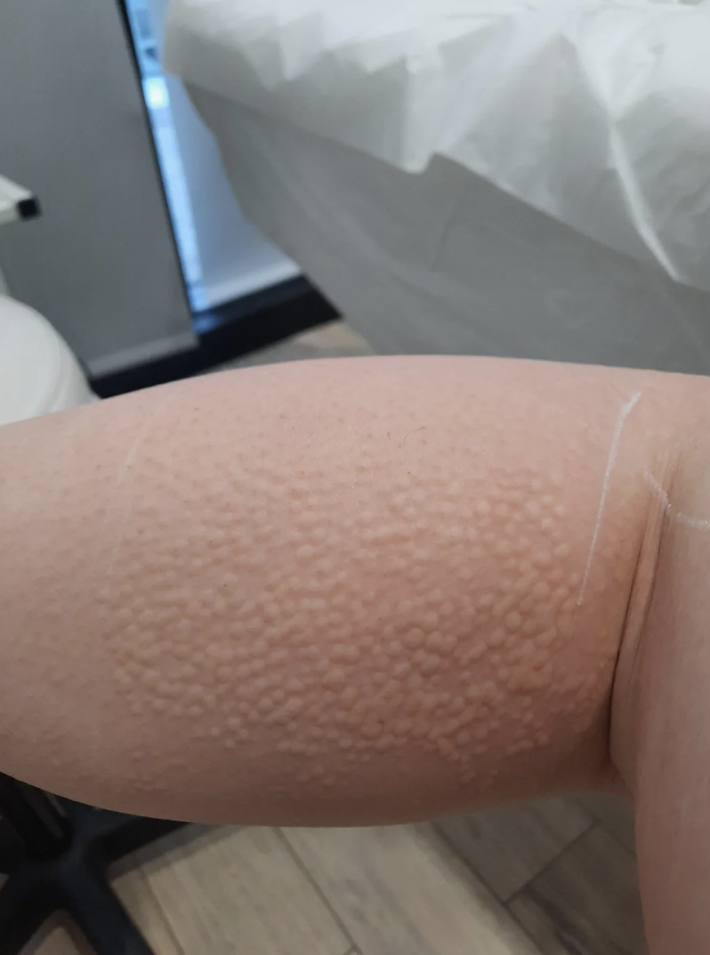 a lot of tiny bumps on their leg