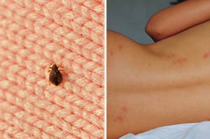 A bed bug seen on a woven blanket next to a woman's bare back with bed bug bites visible