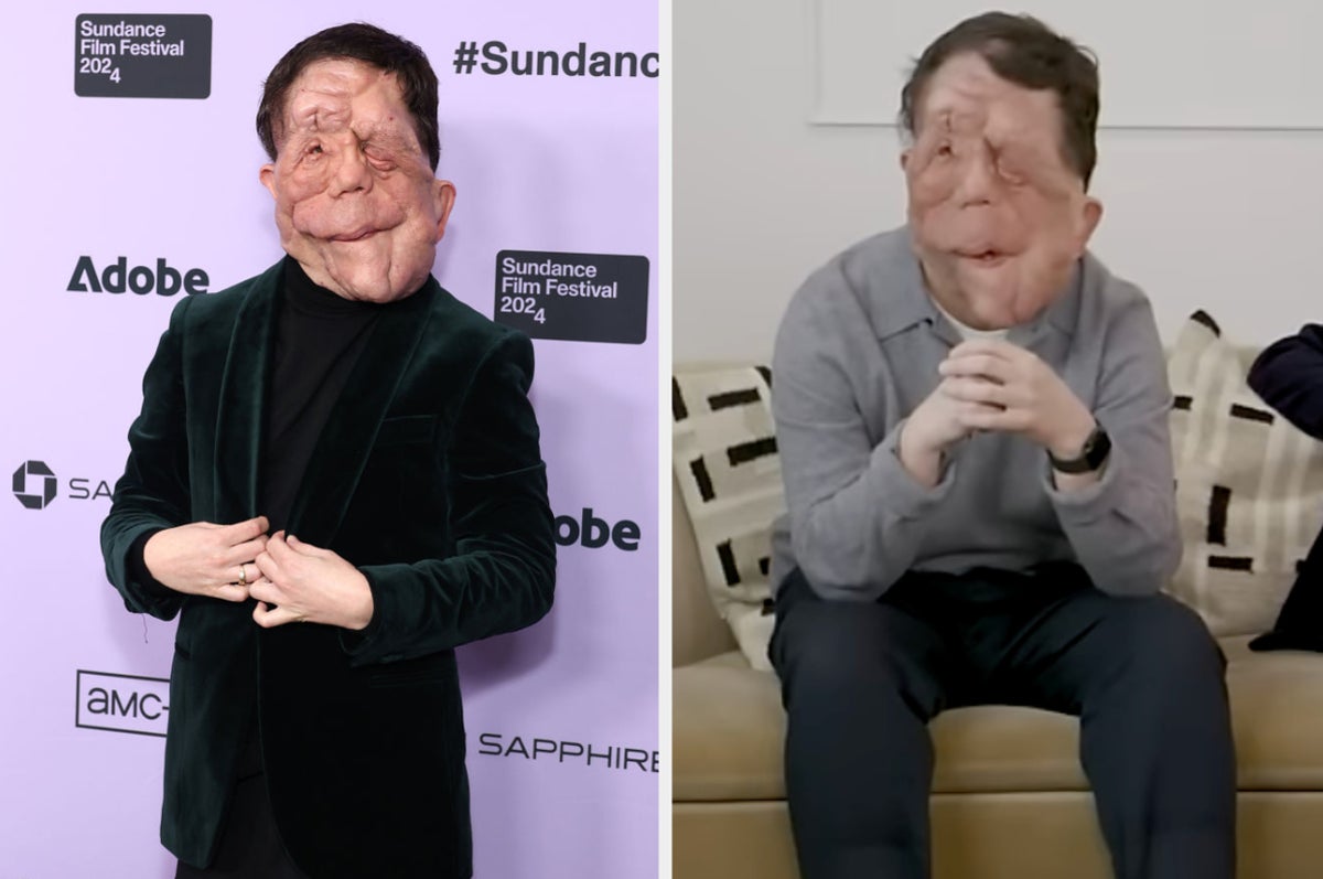 Adam Pearson Says Actors with Disabilities Are Typecast