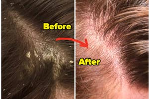 reviewer scalp before and after using treatment