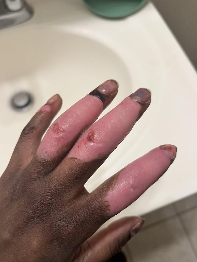 hand is different colors