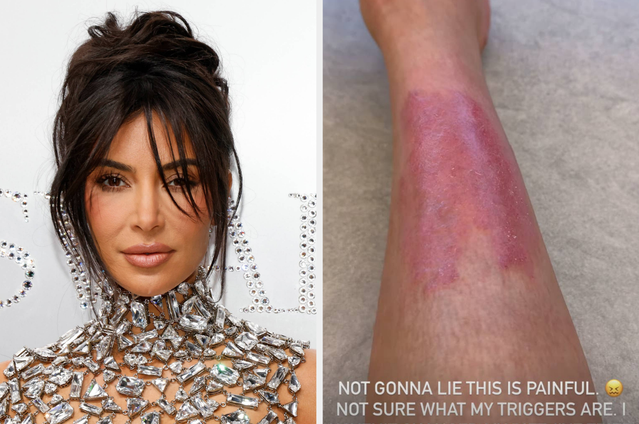 Kim Kardashian Shares Painful Psoriasis Flare Up, Praised