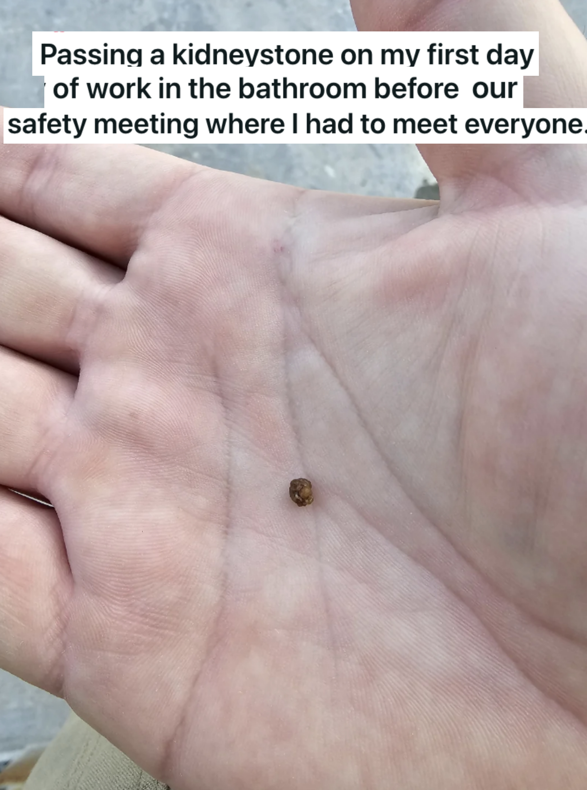 &quot;Passing a kidney stone on my first day...&quot;