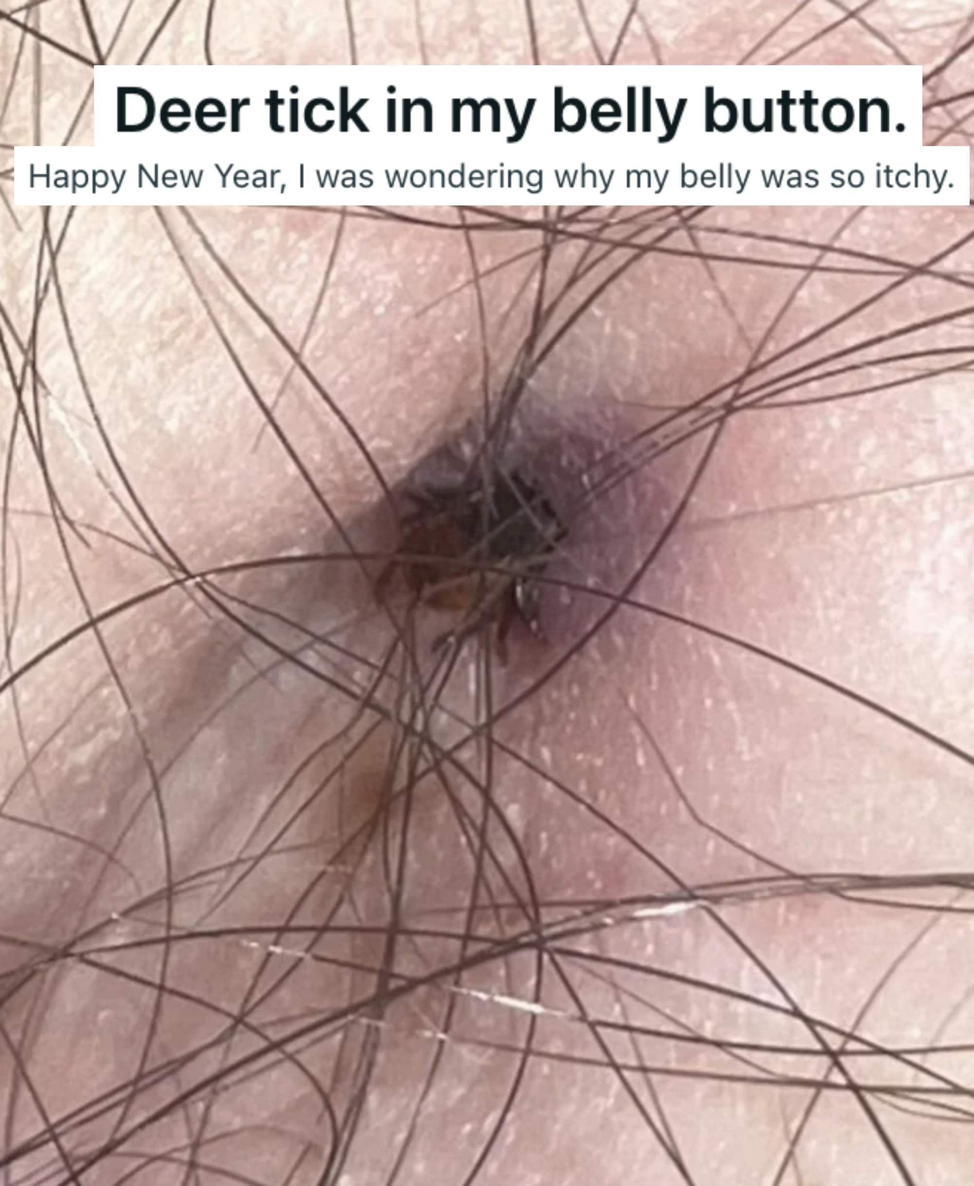 &quot;Deer tick in my belly button&quot;
