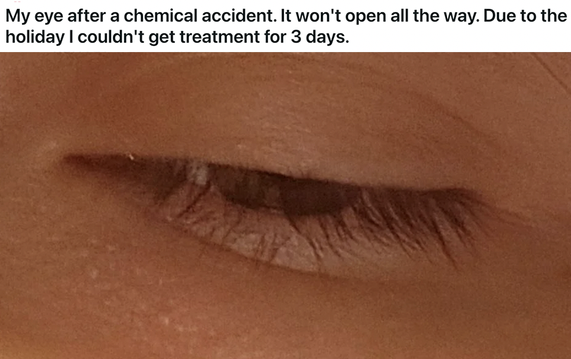 &quot;My eye after a chemical accident&quot;