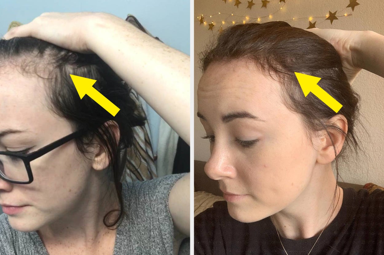 L: a reviewer pulling their hair back to show patchy spots along the scalp, R: the same reviewer with those patches starting to fill in 