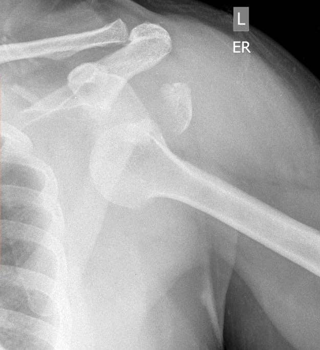 X-Ray of a dislocated shoulder