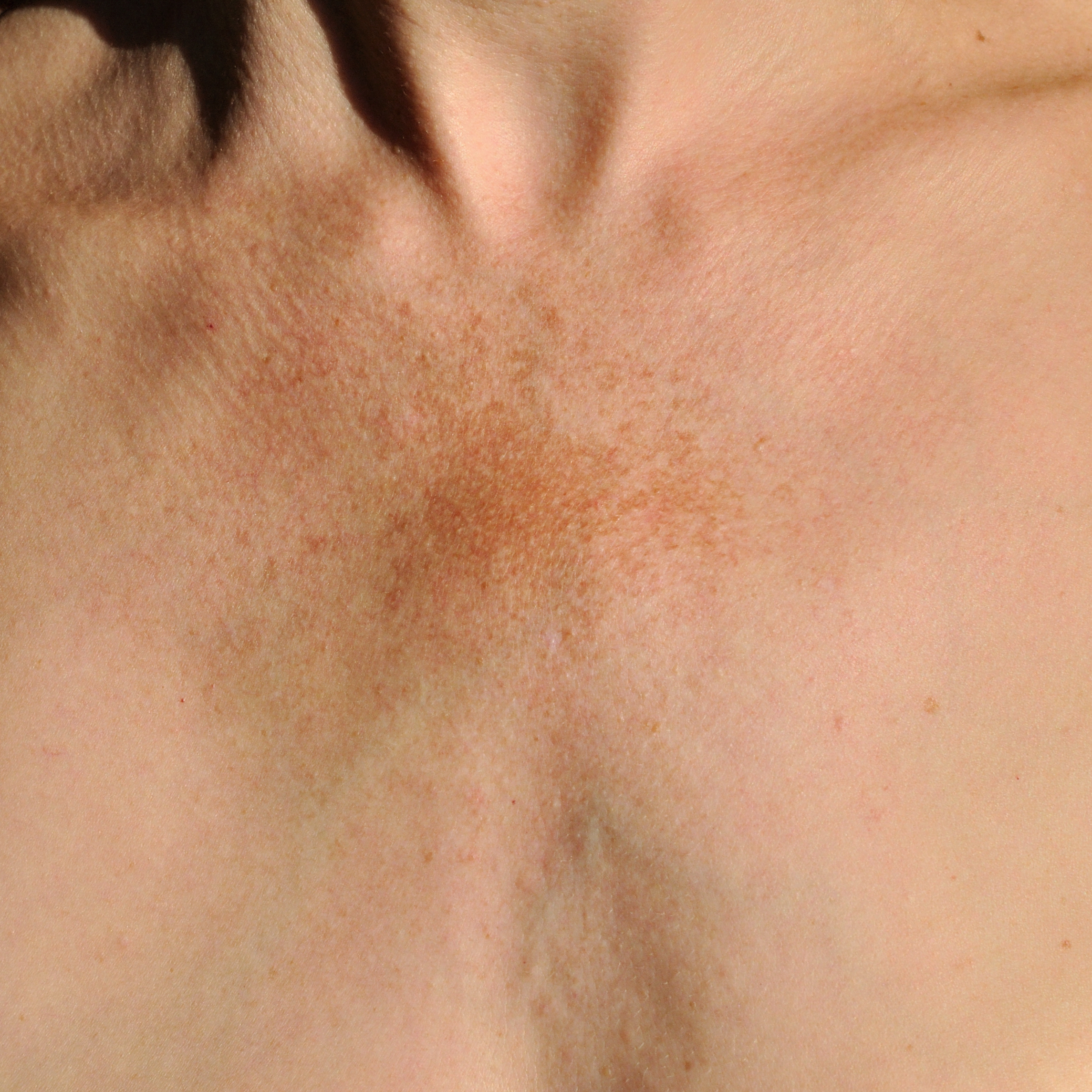 Brown pigment spots on a skin of a middle age woman
