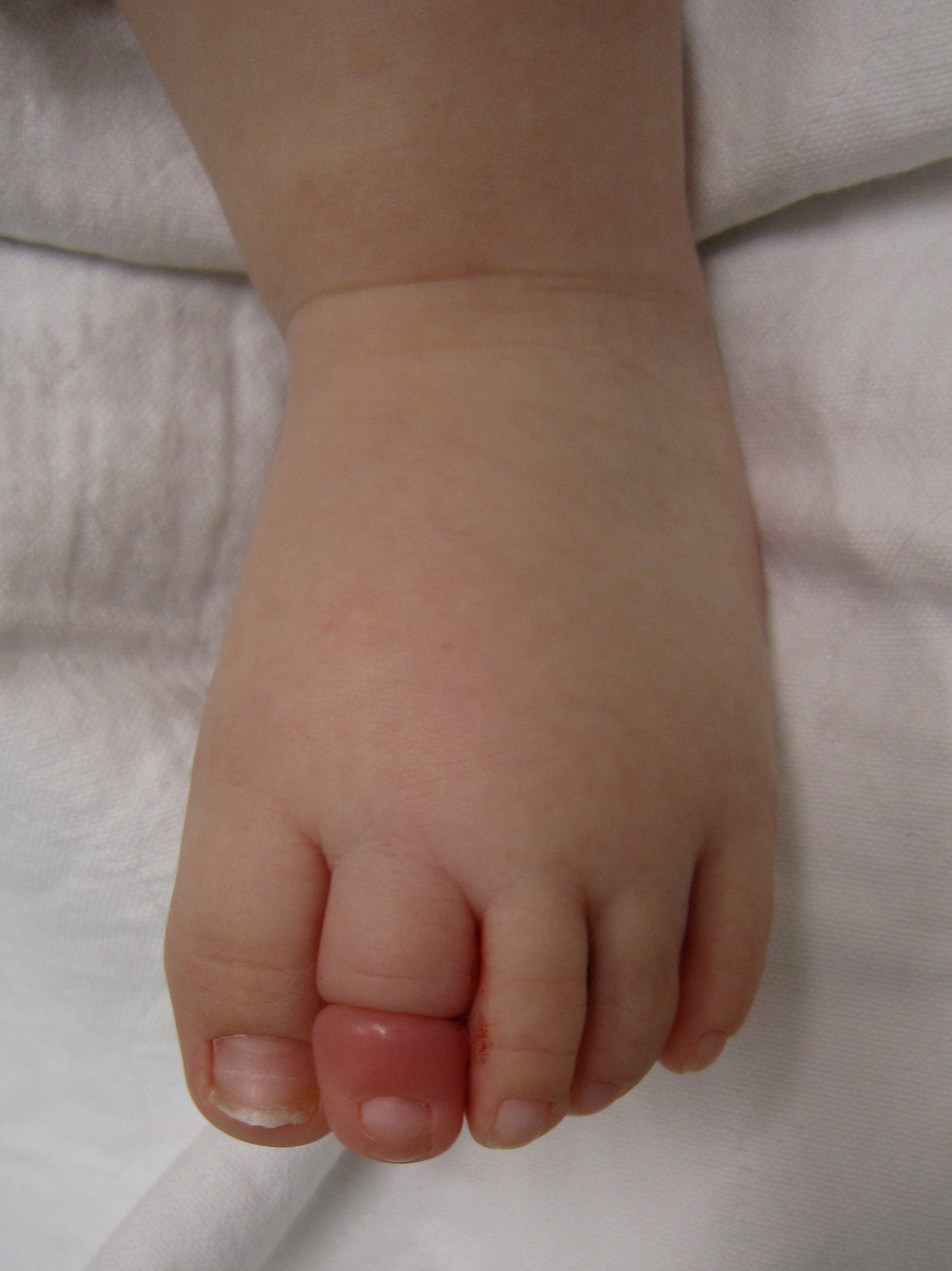 Close-up of a baby&#x27;s toe resting on a white surface, toes gently curled; there is a hair tightly wrapped around one toe that is red