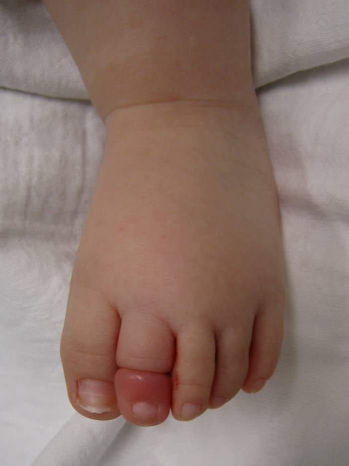 Close-up of a baby&#x27;s toe resting on a white surface, toes gently curled. There is a hair tightly wrapped around one toe that is red.
