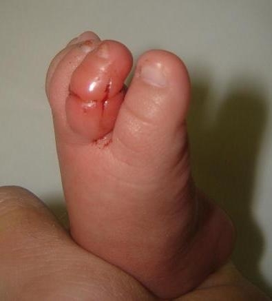 A person&#x27;s hand holding a child&#x27;s foot with a swollen, red, slightly bleeding toe