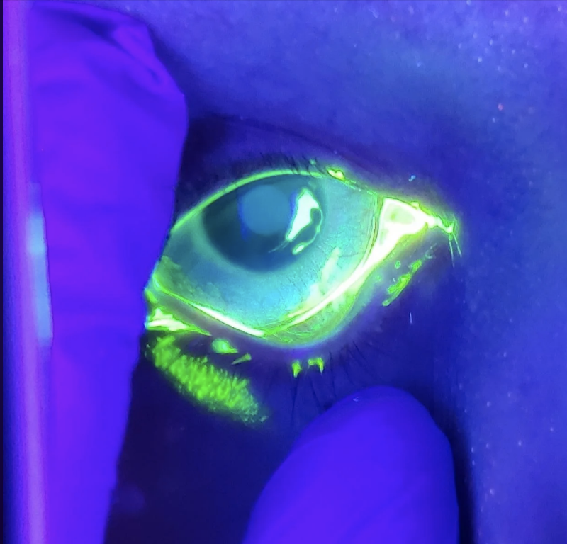 Close-up of a human eye under ultraviolet illumination