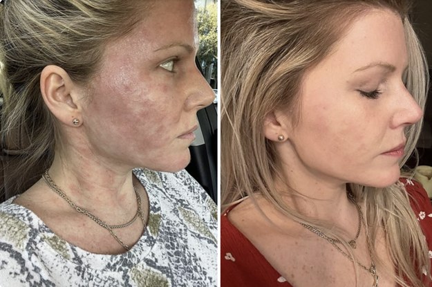 31 Skincare Products With Before & After Photos So Dramatic, We