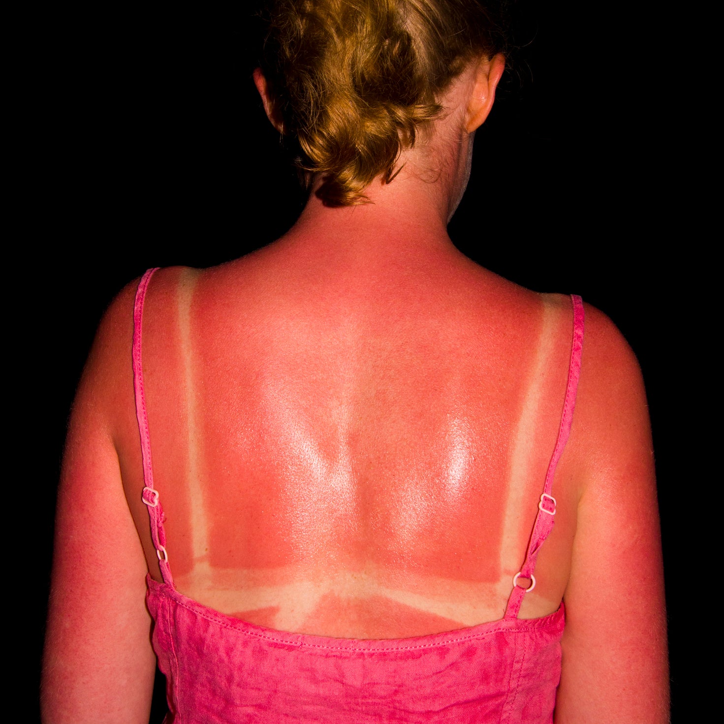 Person with sunburn on back and shoulders, contrasting with pale skin under spaghetti strap top