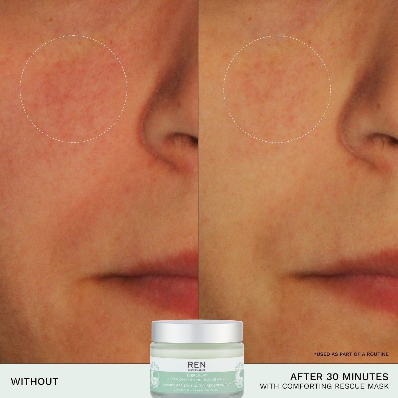 before-and-after of model with redness (left) and less redness (right) on face after using the mask