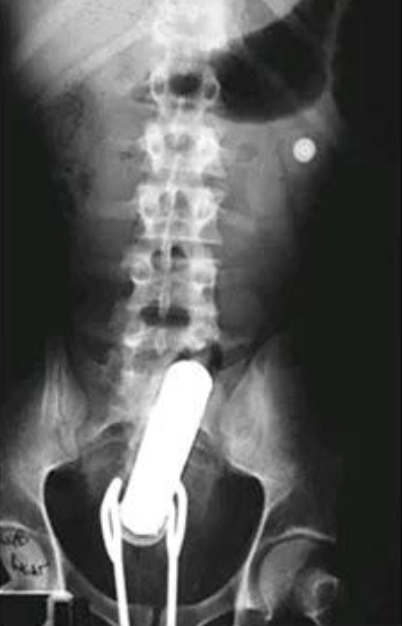 X-ray showing a large object resting in the lower abdomen