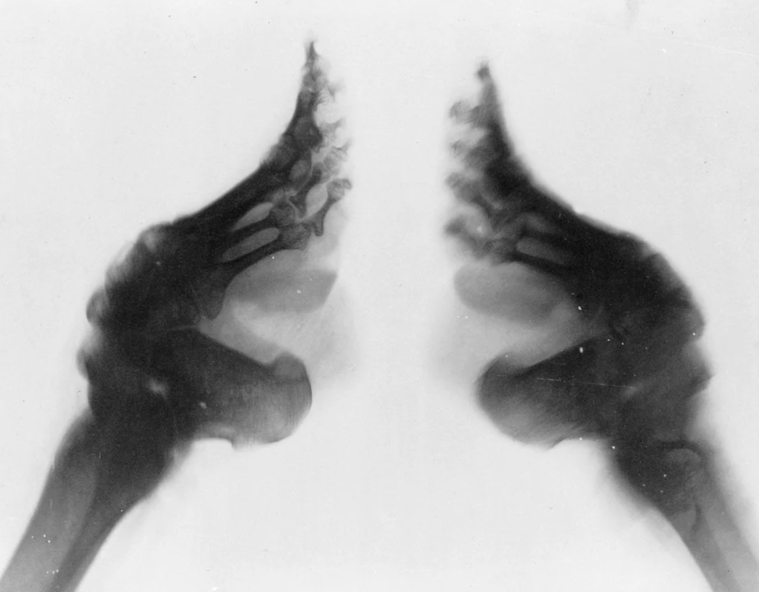 X-ray image showing two feet bent in an unusual way