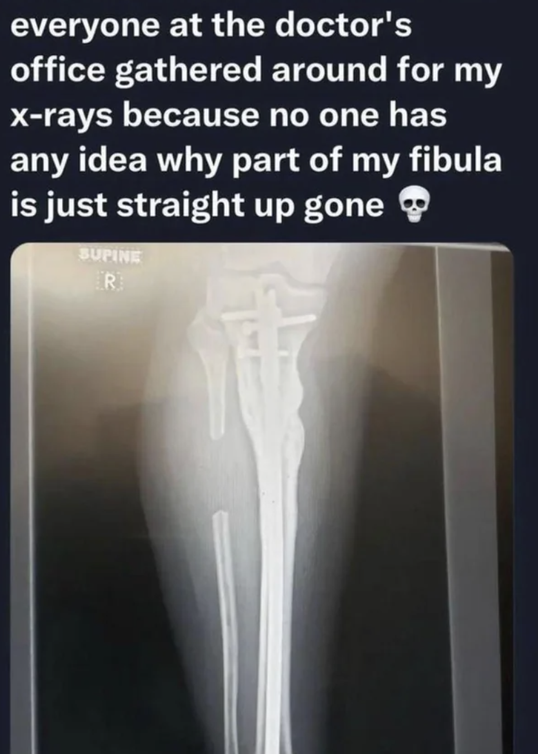 X-ray showing a missing section of the fibula bone, generating interest at the doctor&#x27;s office