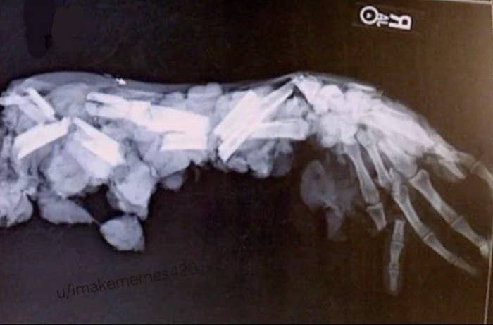 X-ray showing shattered arm