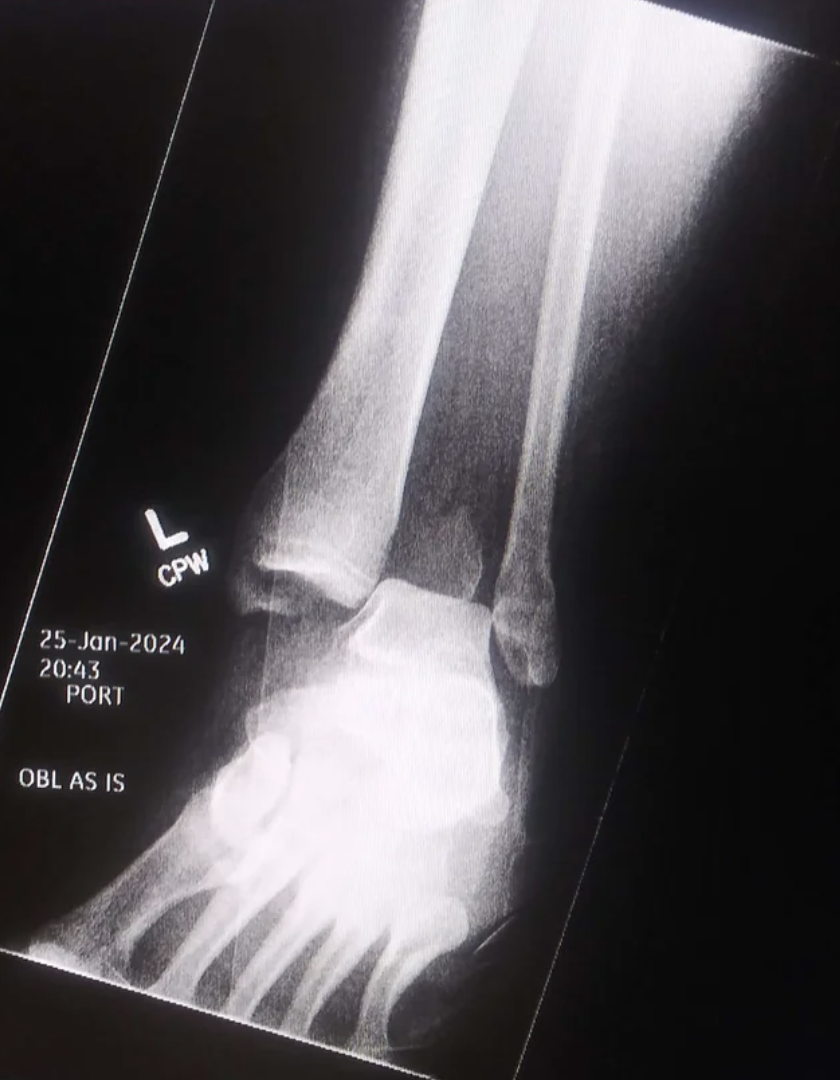 X-ray of a human broken ankle and foot showing bone structure